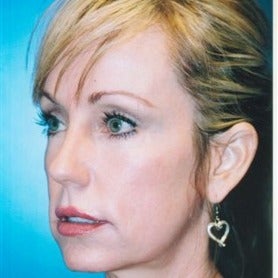 45-54 year old woman treated with Cheek Augmentation before 1726694