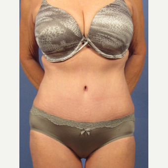 55-64 year old woman treated with Tummy Tuck after 3095736