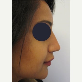 25-34 year old woman treated with Non Surgical Nose Job using Juvederm Volift after 1919069
