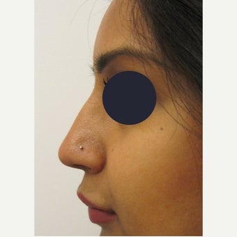 25-34 year old woman treated with Non Surgical Nose Job using Juvederm Volift 1919069