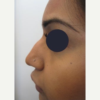 25-34 year old woman treated with Non Surgical Nose Job using Juvederm Volift 1919069