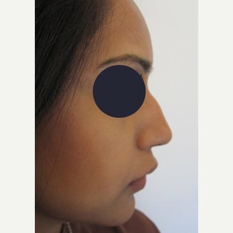 25-34 year old woman treated with Non Surgical Nose Job using Juvederm Volift before 1919069