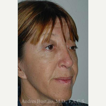 49 year old woman treated with Revision Rhinoplasty after 3460667