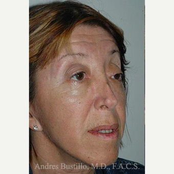 49 year old woman treated with Revision Rhinoplasty before 3460667
