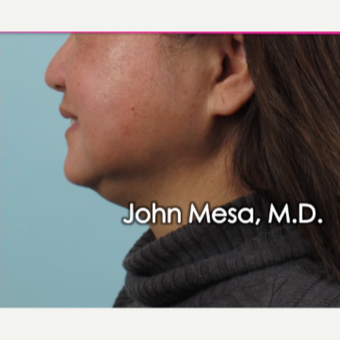 55-64 year old woman treated with Buccal Fat Removal before 3777340