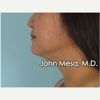 55-64 year old woman treated with Buccal Fat Removal after 3777340
