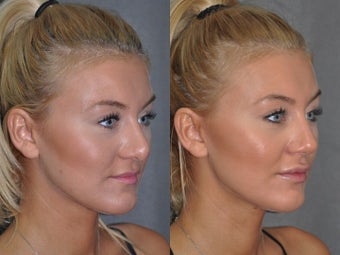 Revision Rhinoplasty performed Closed (endonasal) 1521382