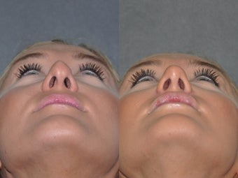 Revision Rhinoplasty performed Closed (endonasal) after 1521382