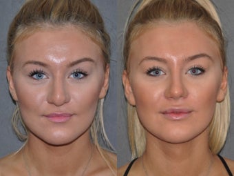Revision Rhinoplasty performed Closed (endonasal) before 1521382