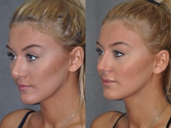 Revision Rhinoplasty performed Closed (endonasal) 1521382