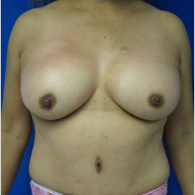 Mommy Makeover after 2994636