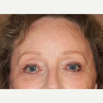 55-64 year old woman treated with Brow Lift after 3295077