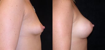Before and after Correction of Breast Asymmetry with Lift One Side and Implants 1093504