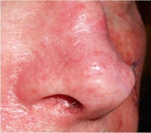 65-74 year old man treated with V Beam for broken blood vessels and telangiectasias on nose. after 1696706