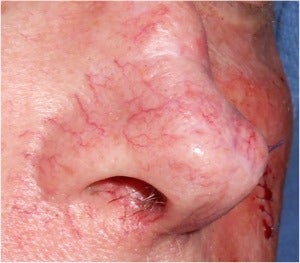 65-74 year old man treated with V Beam for broken blood vessels and telangiectasias on nose. before 1696706
