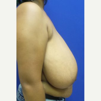 Breast Reduction and Lift before 3838323