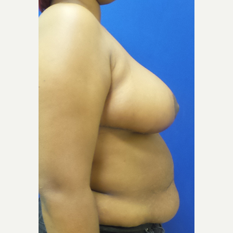Breast Reduction and Lift after 3838323