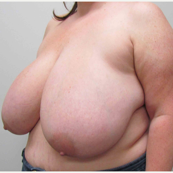 Breast Reduction for this 39 Year Old Woman before 3043145