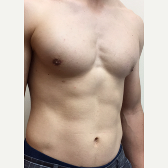 25-34 year old man treated with Gynecomastia Surgery. after 3588391