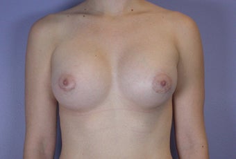 18-24 year old woman treated with Breast Augmentation after 3278098
