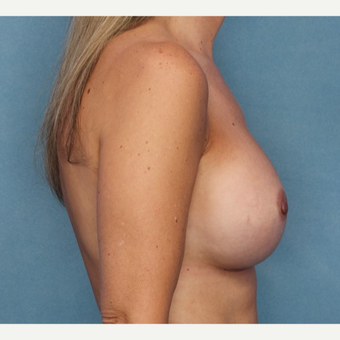 Breast Augmentation after 3062920