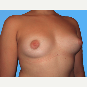 Breast Lift with Implants before 3748799
