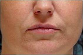 Lip augmentation before 251711