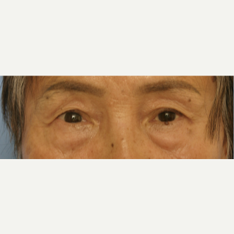 65-74 year old woman treated with Eyelid Surgery before 3503106