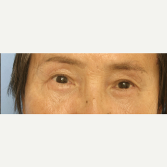 65-74 year old woman treated with Eyelid Surgery after 3503106