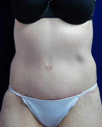 45-54 year old woman treated with Body Lift after 1771458
