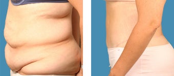 Tummy tuck - 34 year old female after 1144942