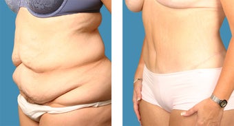 Tummy tuck - 34 year old female 1144942