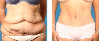 Tummy tuck - 34 year old female before 1144942