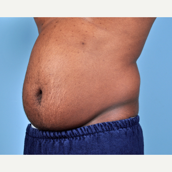 25-34 year old man treated with Liposuction before 3810115
