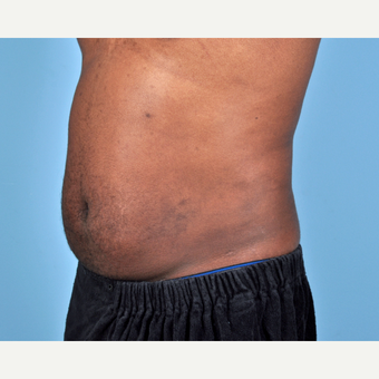 25-34 year old man treated with Liposuction after 3810115