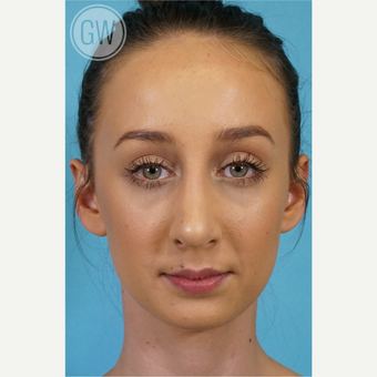 25-34 year old woman treated with Rhinoplasty after 3473403