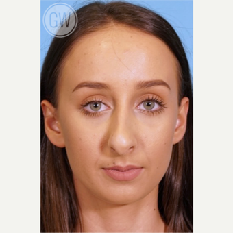 25-34 year old woman treated with Rhinoplasty before 3473403