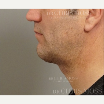 Neck Lift performed on 50 year old male who described his ageing “turkey” neck after 3834704