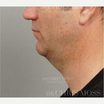 Neck Lift performed on 50 year old male who described his ageing “turkey” neck before 3834704