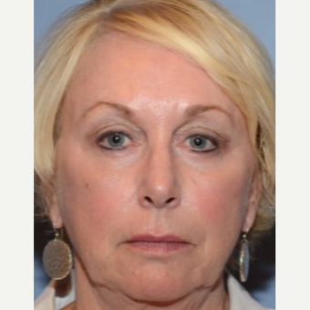 65-74 year old woman treated with Eye Bags Treatment after 3803304