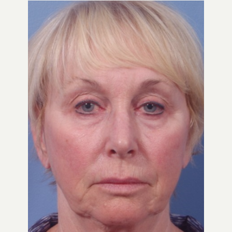 65-74 year old woman treated with Eye Bags Treatment before 3803304