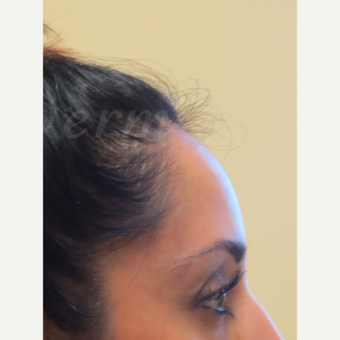 35-44 year old woman treated with Botox after 3381405