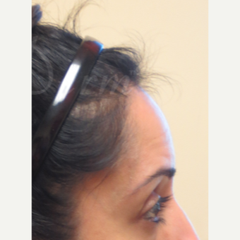35-44 year old woman treated with Botox before 3381405
