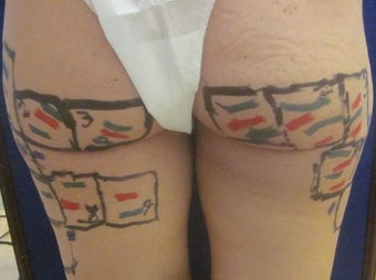 35 Year Old Female Treated 1 Time for Cellulite with Cellulaze Laser 1198881