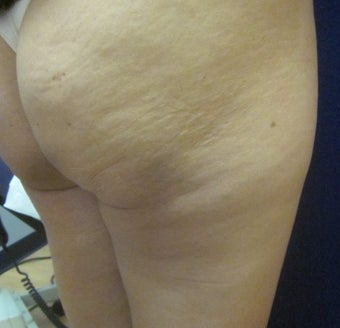35 Year Old Female Treated 1 Time for Cellulite with Cellulaze Laser before 1198881