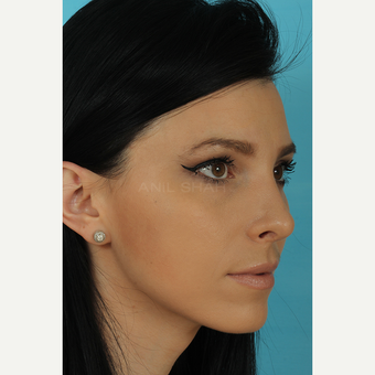 25-34 year old woman treated with Rhinoplasty after 3628743