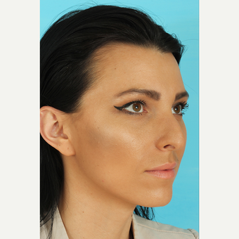 25-34 year old woman treated with Rhinoplasty before 3628743