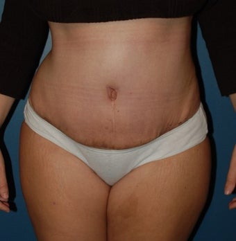 Tummy Tuck after 1270672