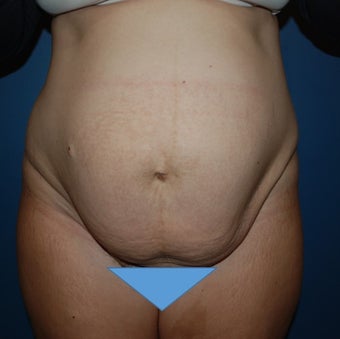 Tummy Tuck before 1270672
