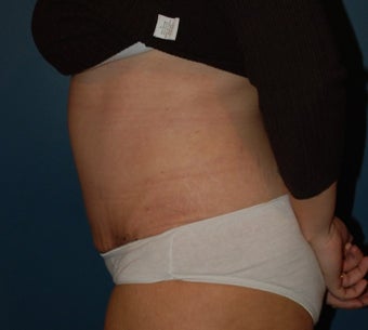 Tummy Tuck 1270672